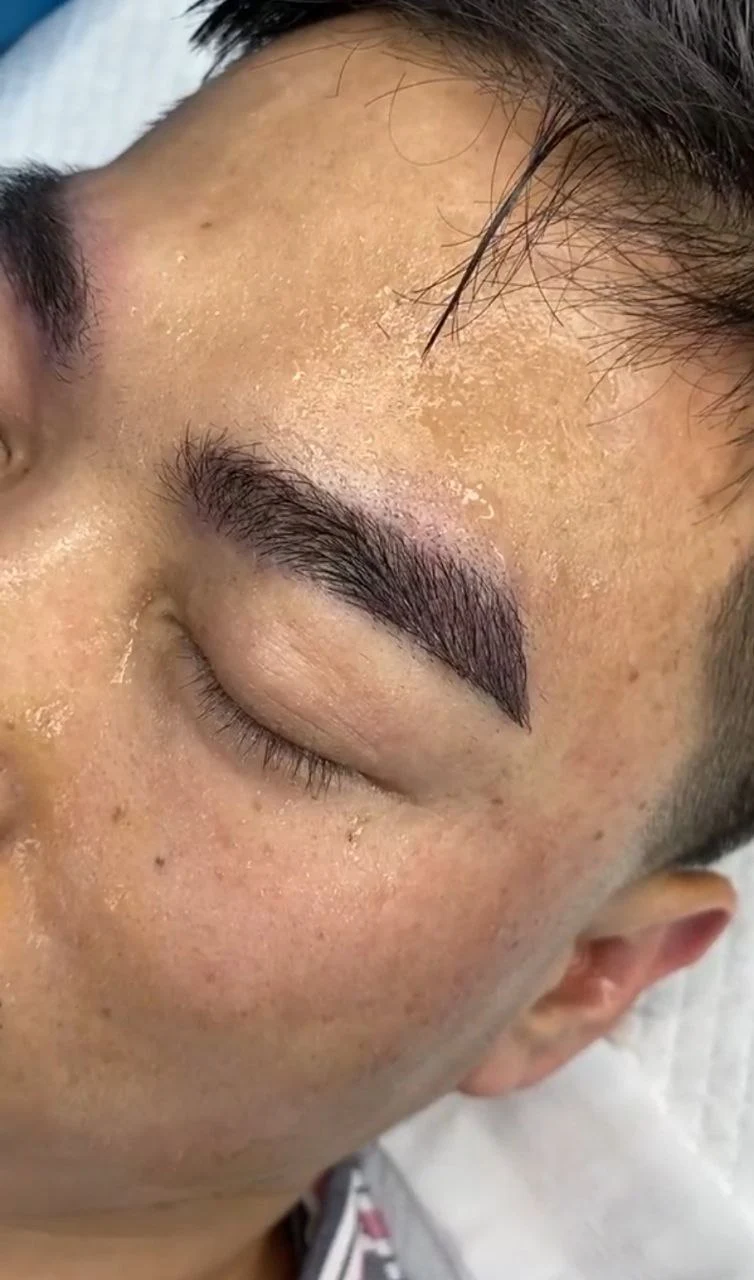 Hair transplant result example 6